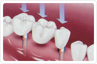 Dental Implants