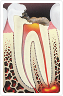 Root Canal