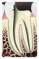 Root Canal