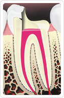 Root Canal