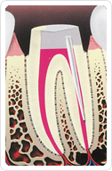 Root Canal