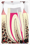 Root Canal